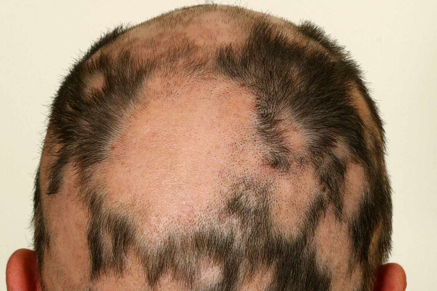 Alopecia areata-Causes-Diagnosis-Best treatment options-Best Homeopathic doctor in Pakistan-Dr Qaisar Ahmed