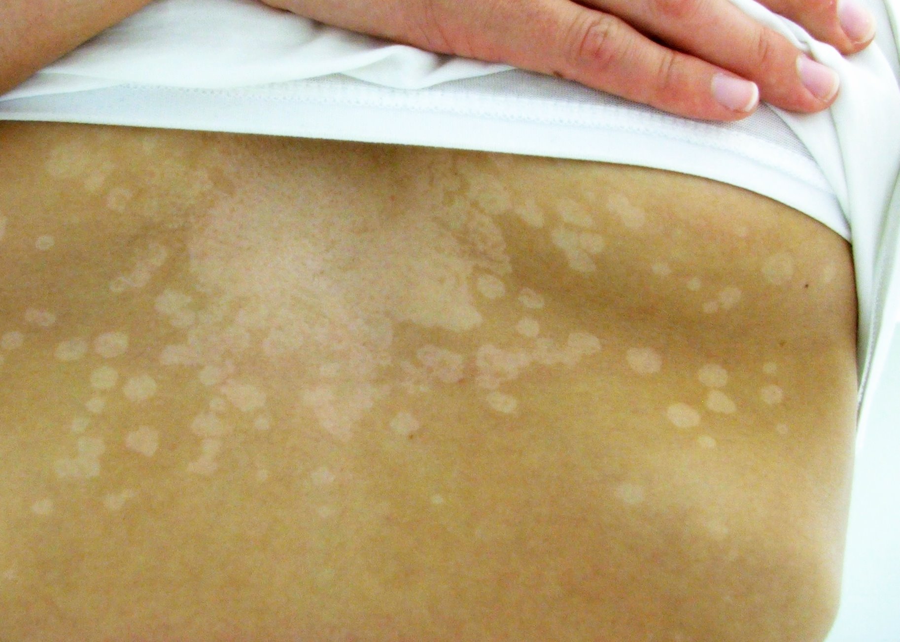 Tinea Versicolor or Pityriasis Versicolor-Causes-Diagnosis-Best Treatment-Best Homeopathic doctor in Pakistan-Dr Qaisar Ahmed-Al Haytham clinic-Risalpur