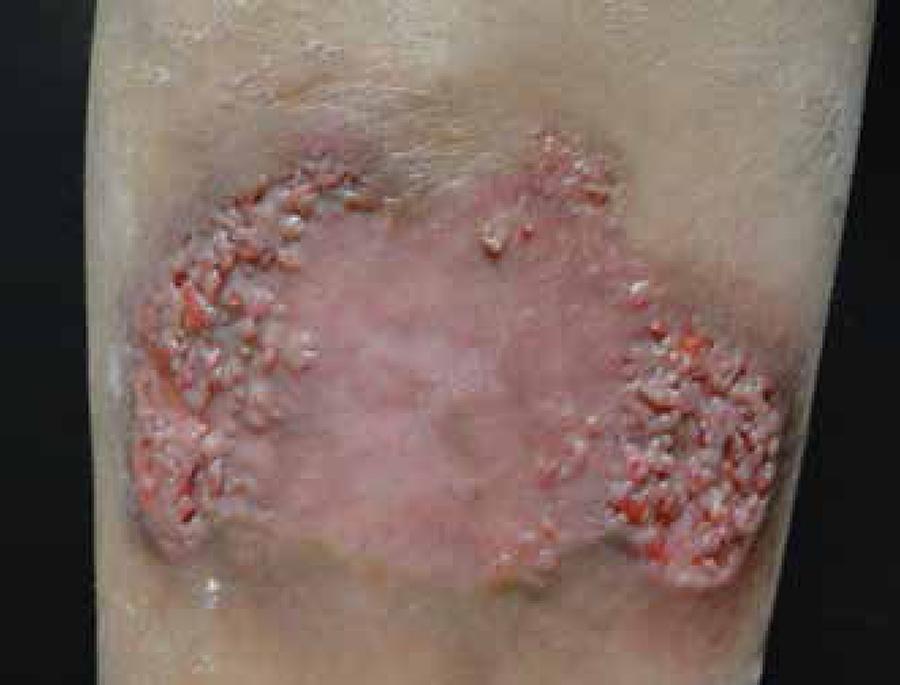 Coccidioidomycosis-Velly fever-causes-Symptoms-Diagnosis-Allopathic and Homeopathic Treatment-Dr. Qaisar Ahmed