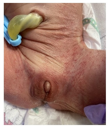 Ambiguous Genitalia-Best Treatment Options-Homeopathy-Dr Qaisar Ahmed