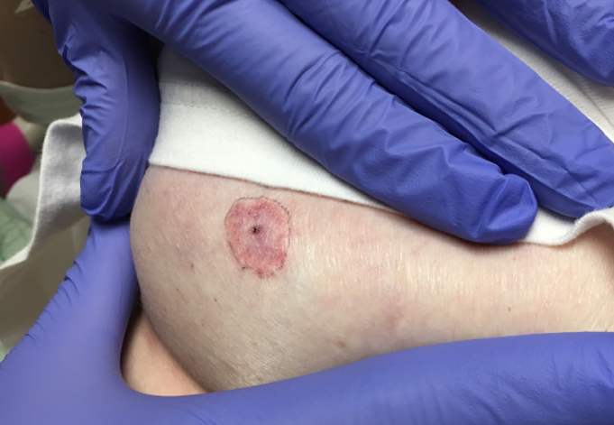 Anaplasmosis - Lyme disease | Homeopathic | Best Homeopathic Doctor in Pakistan | Dr Qaisar Ahmed MD, DHMS