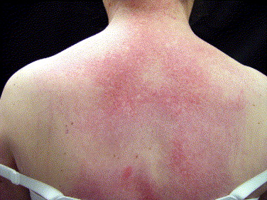 Heliotrope Rash-Myositis- Dermatomyositis-Causes-Diagnosis-Treatment-Dr Qaisar Ahmed