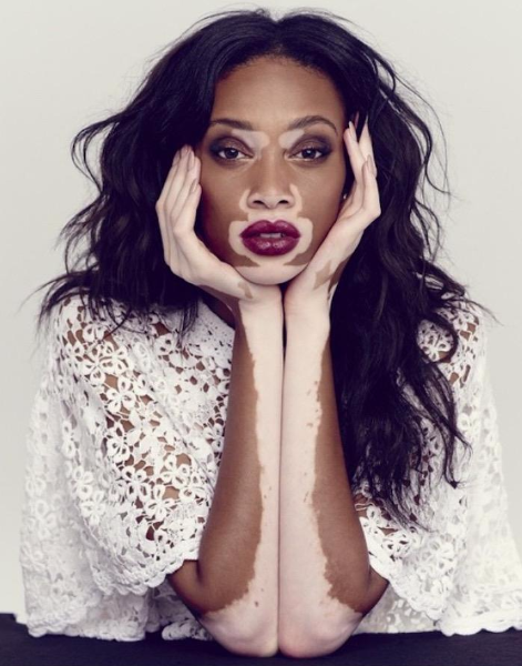 Vitiligo And Leukoderma | treatment | Homeopathic | Best Homeopathic Doctor in Pakistan | Dr Qaisar Ahmed MD, DHMS