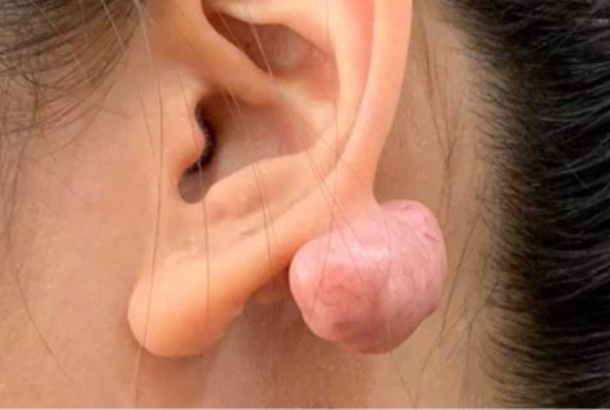 Keloid-Best Treatment Option| Homeopathic | Best Homeopathic Doctor in Pakistan | Dr Qaisar Ahmed MD, DHMS